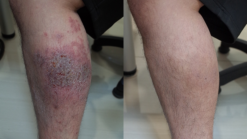 09_腿部濕疹