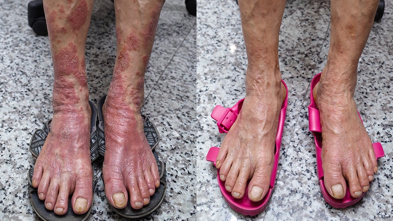 22_腿部乾癬