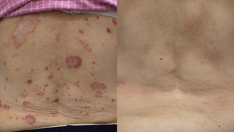 25_手、腰、腹部乾癬