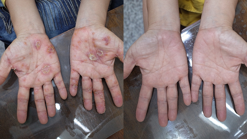 51_手腳濕疹