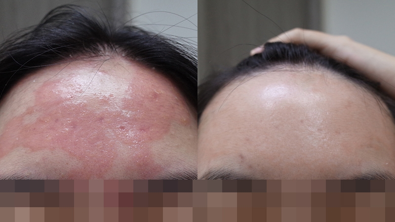 55_頭部乾癬