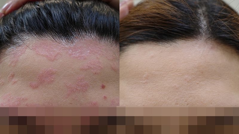 56_頭部頸部乾癬