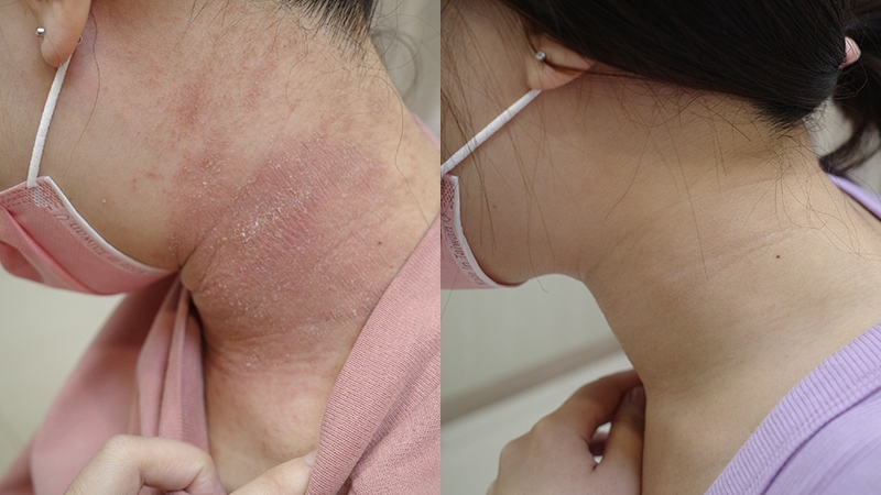 60_手腳、頸部濕疹