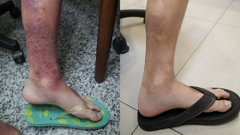 64_腿部濕疹