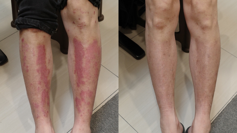 74_腿部乾癬