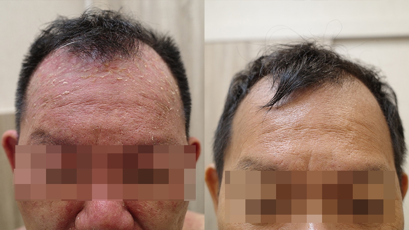 75_頭頸腳部濕疹